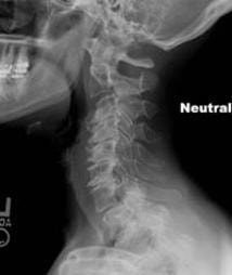 Lateral cervical spine X-ray showing neutral position and degenerative changes in the vertebrae
