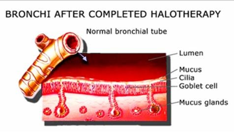Diagram of bronchi after completed halotherapy showing normal bronchial tube with healthy lumen, mucus, cilia, goblet cells, and mucus glands