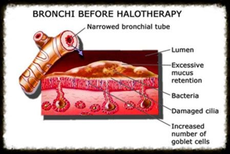 Diagram of bronchi before halotherapy showing narrowed bronchial tube, excessive mucus retention, bacteria, damaged cilia, and increased goblet cells